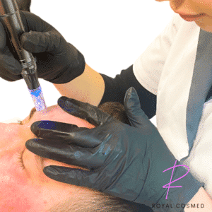 B RC Mesoterapianesteet ja mikroneulaus 21.2 Tampere